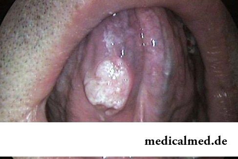 Симптомы рака языка