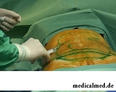 Абдоминопластика - пластическая операция по коррекции живота