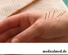 Су джок акупунктура - лечение различных заболеваний через определенные точки на ладонях рук и стопах