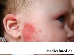 Характерный признак аллергии у детей - сыпь