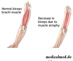 Атрофия мышц - один из симптомов бокового амиотрофического склероза