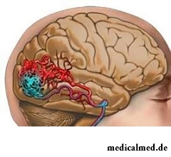 Гипертензия и головные боли - симптомы ангиомы головного мозга