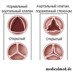 Аортальный стеноз - сужение просвета устья аорты из-за изменений клапана