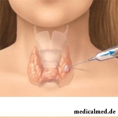 Пункционная биопсия щитовидной железы