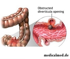 Дивертикулит - воспаление дивертикул