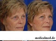 До и после круговой подтяжки лица