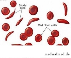 Аутоиммунная гемолитическая анемия - разрушение эритроцитов