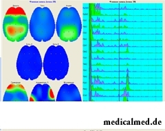 Электроэнцефалография головного мозга
