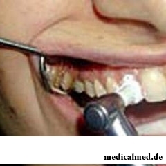 После проведения операции по удалению кисты зуба больному назначаются антибиотики