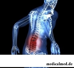Сильная боль в спине - симптом кисты позвоночника
