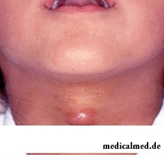 Киста щитовидной железы - узловое образование с полостью, заполненной жидкостью