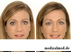 До и после контурной пластики лица