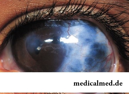 Вроженная глаукома