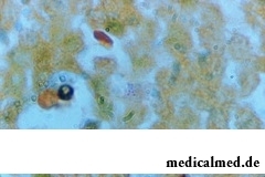 Лимфогранулематоз – pлокачественная опухоль, образованная клетками лимфоидной ткани