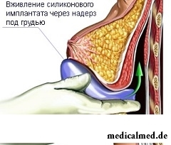 Маммопластика - коррекция формы и/или размера груди