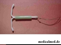 Спираль Мирена - средство контрацепции