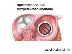Протезирование митрального клапана - один из методов лечения митрального стеноза