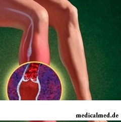 Боль после физической нагрузки - один из первых симптомов нарушения кровообращения нижних конечностей