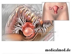 Параовариальной кистой называется полое новообразование, образующееся из ткани придатка яичника
