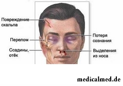 Перелом основания черепа - это опаснейшая травма