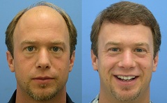 До и после пересадки волос
