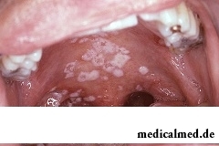 Кандидоз полости рта - заболевание, вызванное грибками рода кандида