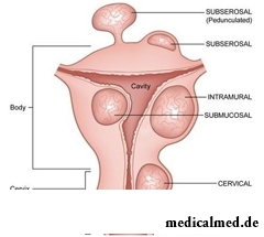 Prichiny endometrita