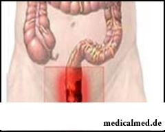 Проктит - воспалительное заболевание слизистой оболочки прямой кишки
