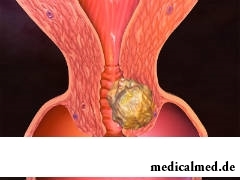 Рак эндометрия является лидером по распространенности среди всех онкологических заболеваний