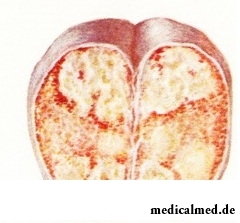 Появление узелка - симптом рака яичка