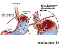 Рефлюкс-эзофагит - заброс желудочного содержимого в пищевод