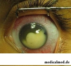 Первый симптом болезни - покраснение глаза