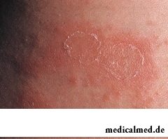 Розовый лишай - инфекционно-аллергическое заболевание