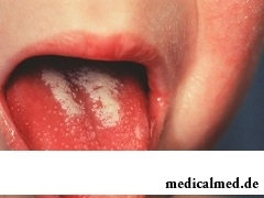 Явный симптом скарлатины - внешний вид поверхности языка