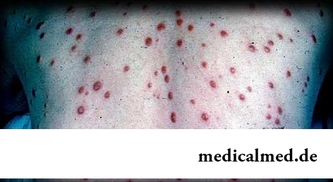 проявление сифилиса на спине у болеющего человека