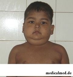 Основные симптомы синдрома Иценко-Кушинга - ожирение туловища, шеи и лица