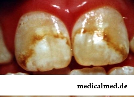 Симптомы флюороза зубов