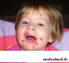 У детей стрептодермия чаще всего проявляется в виде лишая