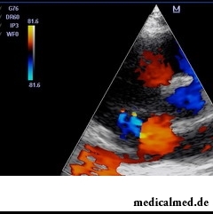 Для диагностики трикуспидальной регургитации выполняют ЭКГ и рентгенографию грудной клетки
