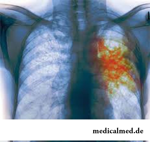 Рентген больного туберкулезом человека