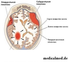Виды внутричерепных гематом