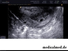 УЗИ на 3 неделе беременности показывает плодное яйцо на стадии имплантации в стенку матки
