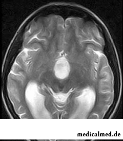 Арахноидальная киста головного мозга на снимке МРТ