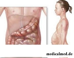 Болезнь Гиршпрунга – одна из наиболее распространенных аномалий развития толстого кишечника