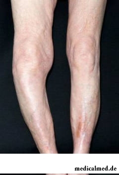 При болезни Педжета ноги приобретают X- или О-образную форму