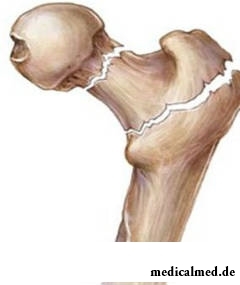 Болезнь Педжета - деформирующее заболевание костей