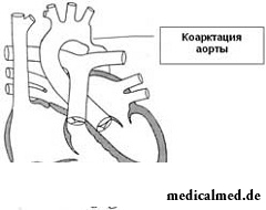 Коарктация аорты - врожденное заболевание