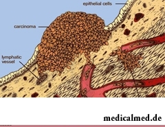 Феохромоцитома