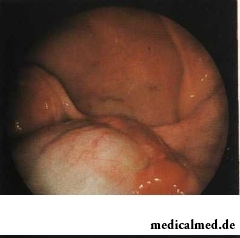 Нередко фиброма яичника сочетается с кистой яичника