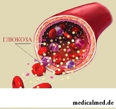 Гипергликемия - повышенное содержание в крови глюкозы